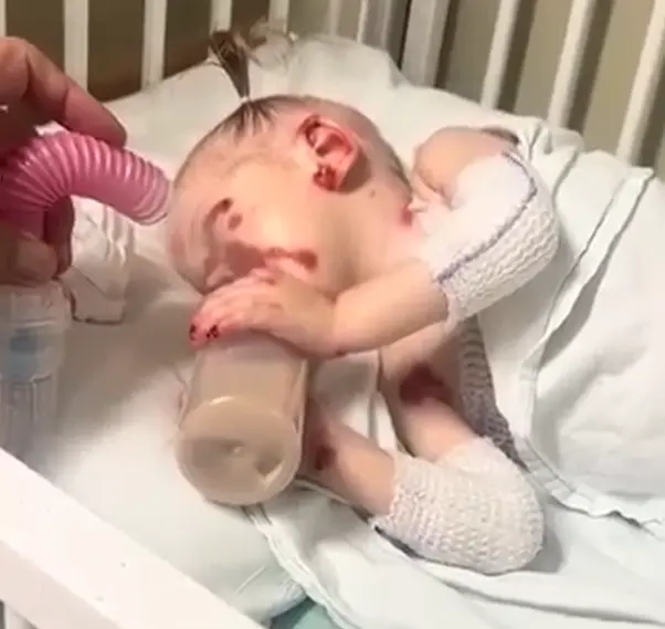 Agatha durante a rotina de curativos e cuidados diarios